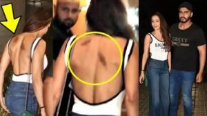 अर्जुन कपूर ने किया मलाइका अरोड़ा ऐसा बुरा हाल, पीठ पर दिखे गहरे चोट के निशान